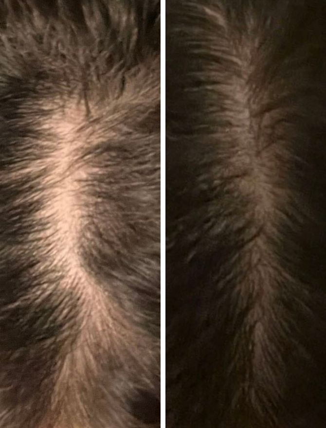 What Causes Female Hair Loss? Everything You Need To Know