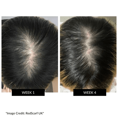 CurrentBody Skin LED Hair Regrowth Device - Black Friday Offer