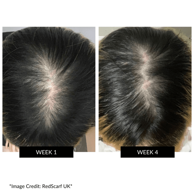 CurrentBody Skin LED Hair Regrowth Device - Black Friday Offer