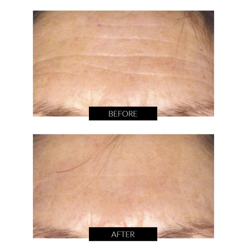 CurrentBody Skin LED Light Therapy Mask + CurrentBody Skin Hydrogel Mask (5 Pack)