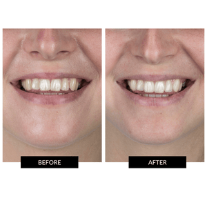 CurrentBody Skin Teeth Whitening Extended Kit