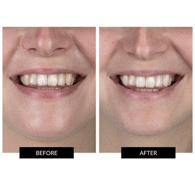 CurrentBody Skin Targeted LED Mouth and Lip Treatment