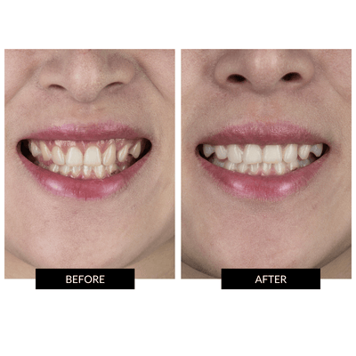 CurrentBody Skin Teeth Whitening Extended Kit