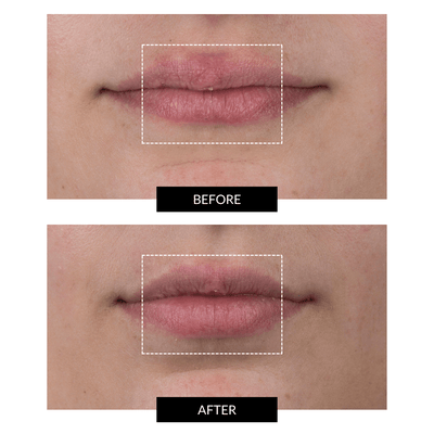 CurrentBody Skin Complete LED Perfect Smile Kit