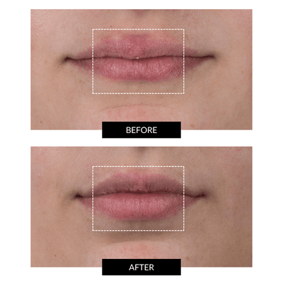 CurrentBody Skin Targeted LED Mouth and Lip Treatment