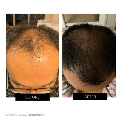 CurrentBody Skin LED Hair Regrowth Device - Black Friday Offer