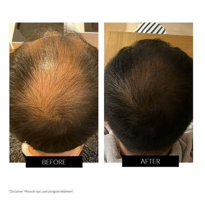 CurrentBody Skin LED Hair Regrowth Device - Black Friday Offer