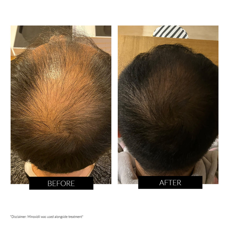 CurrentBody Skin LED Hair Regrowth Device - Black Friday Offer