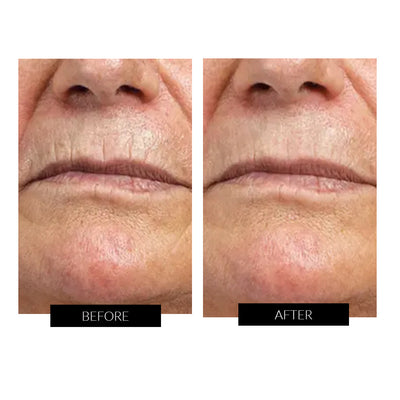 CurrentBody Skin RF Radio Frequency Skin Tightening Device.Hongmall