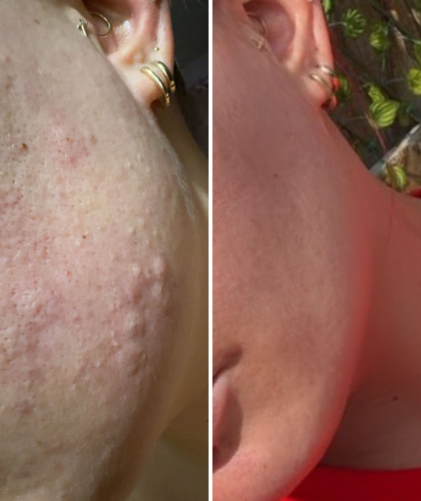 Acne & Blemishes