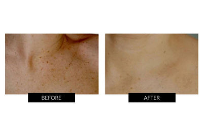TriPollar Stop Facial Skin Renewal Device