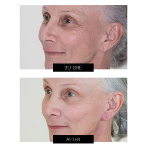 NIRA Pro Anti-Ageing Laser