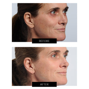 NIRA Pro Anti-Ageing Laser