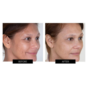 NIRA Precision Anti-Ageing Laser