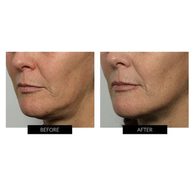 NuFACE Trinity Facial Toning Device Before and After Review