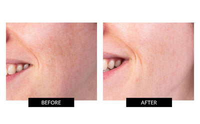TriPollar STOP Facial Skin Renewal Device for improving wrinkles and facial toning before and after photos