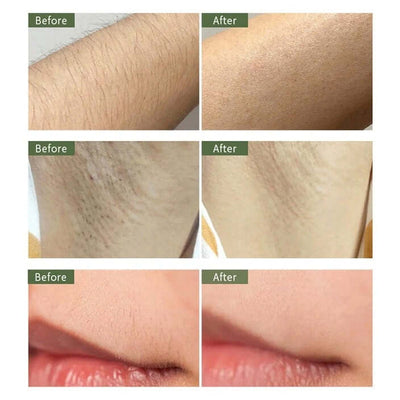 Ulike Rose IPL Hair Removal & Anti-Ageing Device